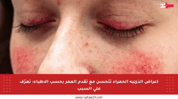 أعراض الذئبة الحمراء تتحسن مع تقدم العمر بحسب الأطباء: تعرّف على السبب